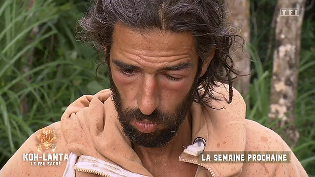 image de la news Koh-Lanta : Mais, qu'est-il arrivé au visage d'Esteban ?!