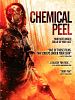 poster de Chemical Peel
